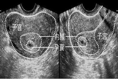 胎兒的性別預測，孕囊的形狀看男女真的準嗎?