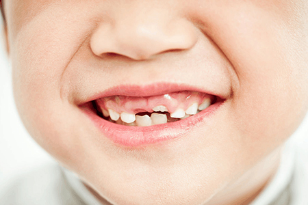 宝宝乳牙一直不掉影响恒牙生长，这些预防你要提前做好