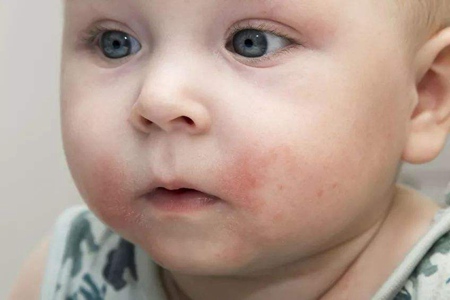 宝宝湿疹反复皮肤红肿，影响睡眠怎么办