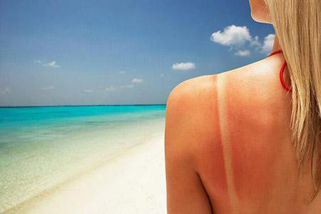 治療夏季曬傷的四種好辦法，修複肌膚受傷狀態