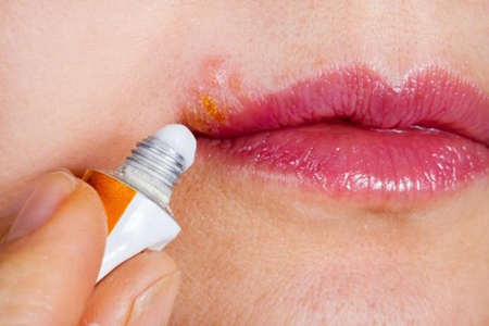 嘴唇上长水泡的五个原因，日常简单消肿的方法