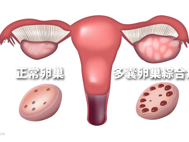 多囊卵巢還能生寶寶嗎 多囊卵巢的備孕方法