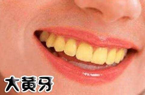 为什么别人的牙齿这么洁白而我们的牙齿就这么黄呢？是什么原因导致了我的大黄牙？