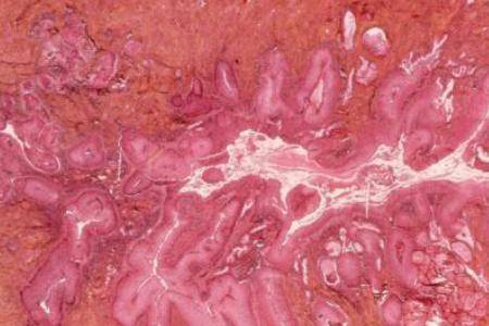 宮頸癌的早期症狀有什麼