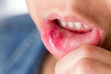 口腔溃疡发病原因