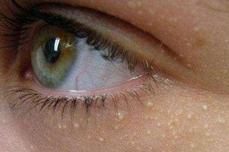 眼部脂肪粒是怎么形成的 八个小妙招帮你轻松解决