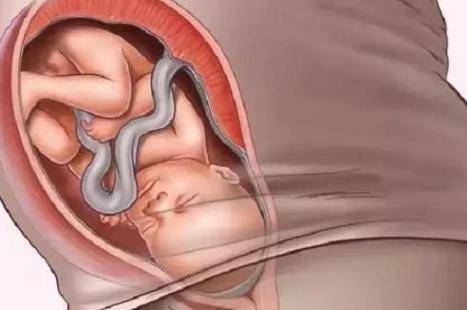 胎儿脐带绕颈的原因和注意事项 脐带绕颈可以顺产吗