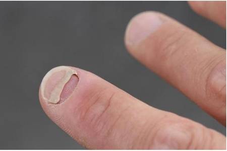 最轻微的灰指甲图片有什么症状，灰指甲怎么治愈最快