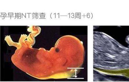 唐氏兒在宮內有什么特征  孕媽媽如何在產檢時檢查出來？