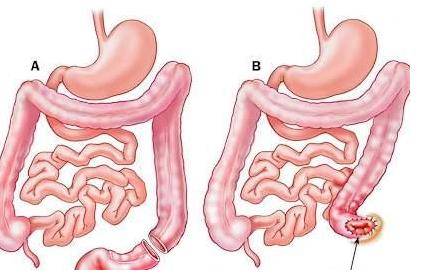 直肠息肉会癌变几率 有直肠息肉一定是癌症吗