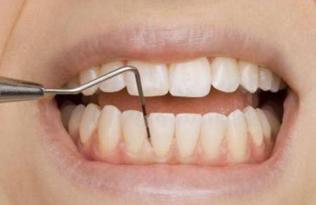 牙周病引起的原因和3个症状 牙周病的治疗方法是哪些