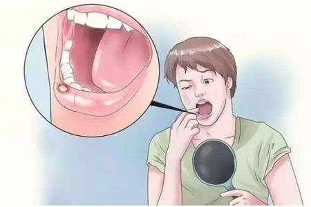口腔潰瘍發病六大原因，小妙招讓你遠離潰瘍疼痛