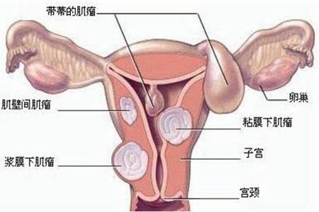 子宫肌瘤是什么原因导致的？预防子宫肌瘤的方法