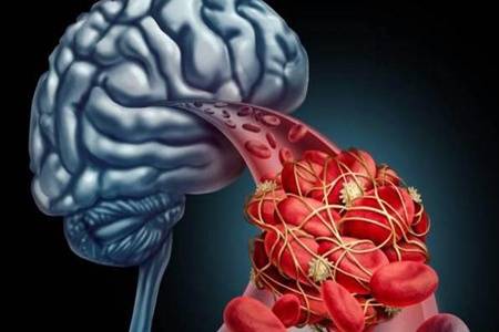 如何預防腦溢血發生 用力過猛會腦溢血是真的嗎