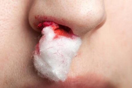 流鼻血是什么原因引起的呢？鼻出血如何快速止血
