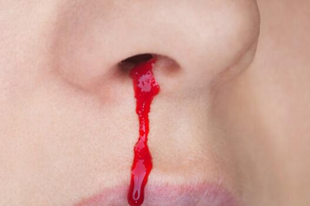 流鼻血是什么原因引起的呢？鼻出血如何快速止血
