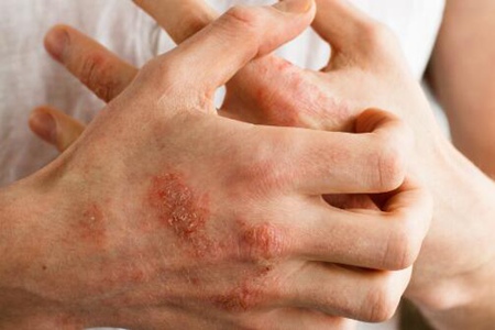 湿疹怎么才能根除？这五个治疗护理方法不再复发
