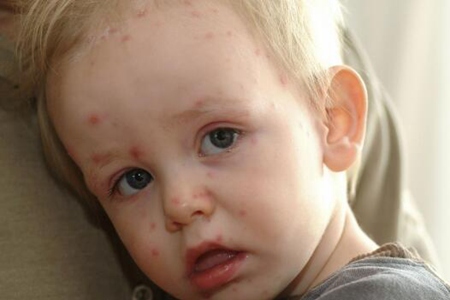 水痘的症状和治疗,患有水痘应如何护理？