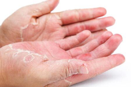 手脱皮是什么原因导致的？这5个因素会导致手脱皮治疗