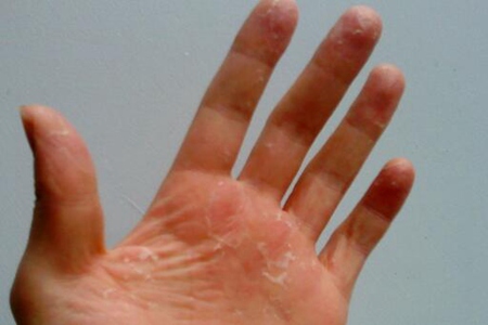 手脱皮是什么原因导致的？这5个因素会导致手脱皮治疗