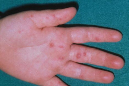 手足口病的主要症状？这五个症状早发生早治疗