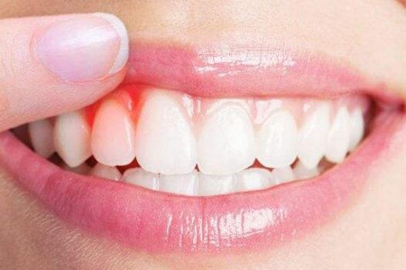 牙龈出血是什么病征兆？这五个疾病要当心不可忽视
