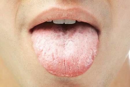舌苔白又厚是怎么回事？这五个原因造成的不要轻视