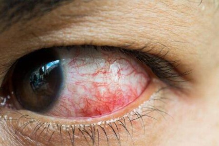 眼睛充血是什么原因引起的起的？这五个病因早干预早安心