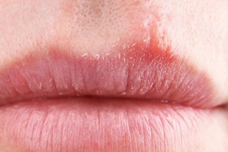 嘴唇上火起泡怎么快速消除？这五个方法教你快速治愈