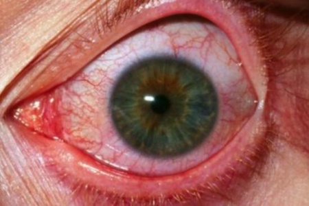 眼睛红红的像出血一样是怎么回事？（离不开这5个因素要及时改善）