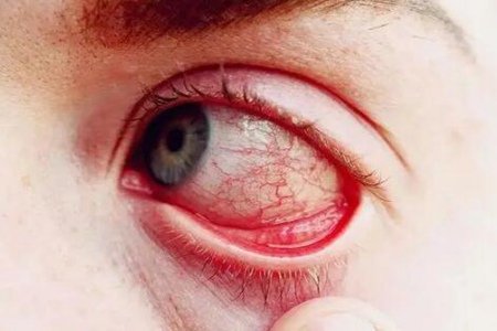 眼睛红红的像出血一样是怎么回事？（离不开这5个因素要及时改善）