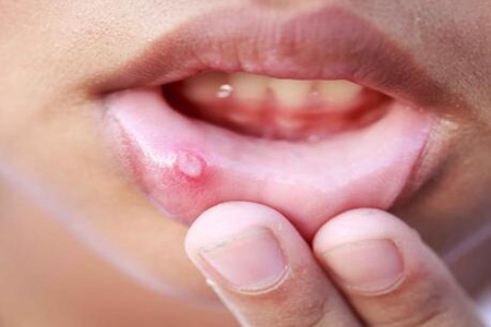 口腔癌早期有什么征兆？（這五個癥狀要留心預警）