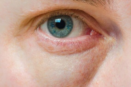 眼睛肿是什么原因？这五个原因造成得要小心防范