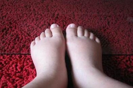 孕妇脚肿是什么原因？（脚水肿期间应该注意什么？）
