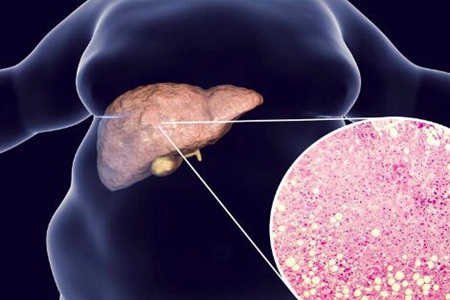 脂肪肝的症状有哪些表现？这五个表现不是能忽视的小病
