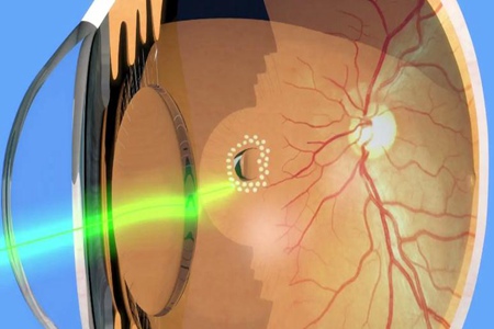 视网膜脱落怎么办 是否意味着眼睛瞎了