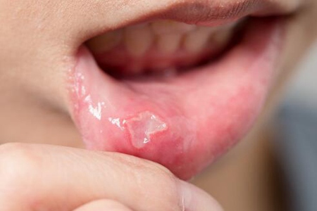 口腔溃疡反复发作怎么根治？这五个方法能缩短复发周期