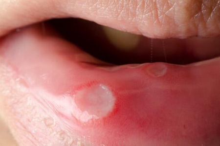 口腔溃疡反复发作怎么根治？这五个方法能缩短复发周期