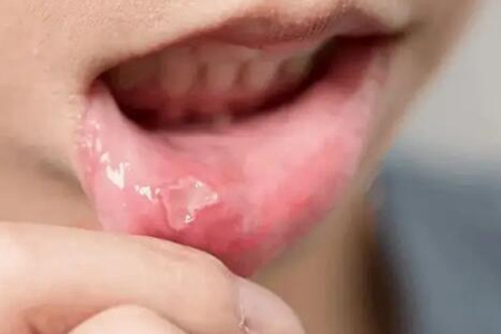 舌頭上潰瘍怎麼治？這四個方法能快速愈合潰瘍