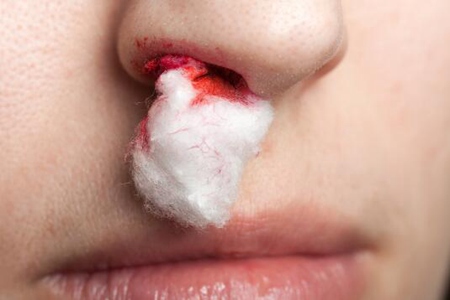 鼻涕带有血丝是什么原因？（鼻出血如何快速止血？）