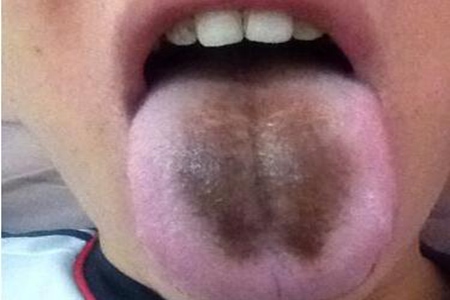 舌苔发黑是什么原因？这四种原因暗示疾病缠身需警惕