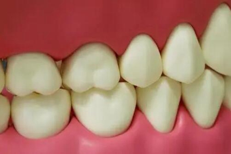 磨牙是什么原因引起？這五個原因有關值得重視改善