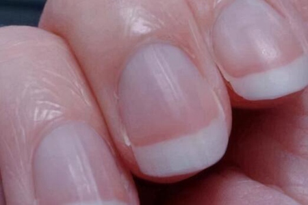 指甲有豎紋什麼原因？這五個症狀引發及時治療改善