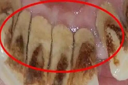  牙结石的危害有什么？这四个危害要及时改良 别毁失落 牙 