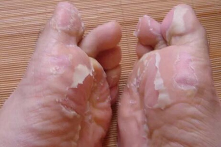 脚气烂脚趾缝痒溃烂怎么治？这三个方法能脚气反复折磨痒