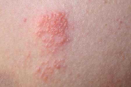 汗皰疹是什么原因引起？這五個因素引發得及時改善治療