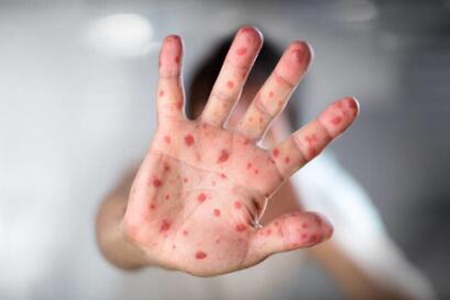 疱疹是因为什么原因引起的？这五个原因提高体质是预防关键