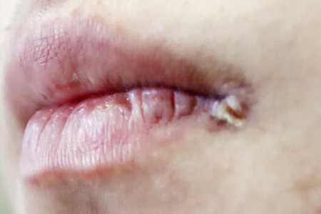 嘴巴上長皰疹是怎么回事？這五個原因親吻別人居然會傳染