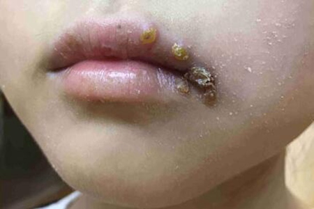 嘴巴上长疱疹是怎么回事？这五个原因亲吻别人居然会传染