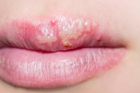 嘴巴上长疱疹是怎么回事？这五个原因亲吻别人居然会传染